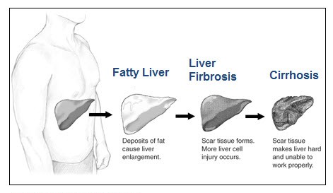 liver cirrhosis alcohol