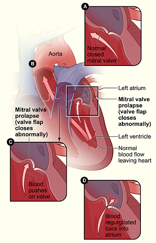 mitralvalve_prolapse